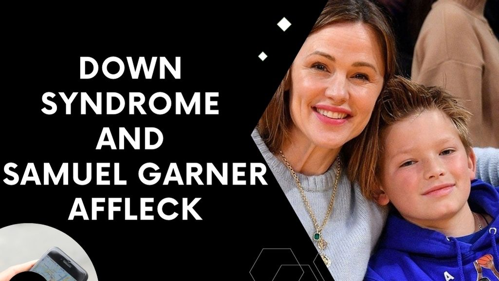 Down Syndrome and Samuel Garner Affleck